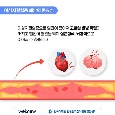 이상지질혈증 예방하기 3장. 이상지질혈증 예방의 중요성. 이상지질혈증으로 혈관이 좁아져 고혈압 발병 위험이 커지고 혈전이 혈관을 막아 심근경색, 뇌경색으로 이어질 수 있습니다.