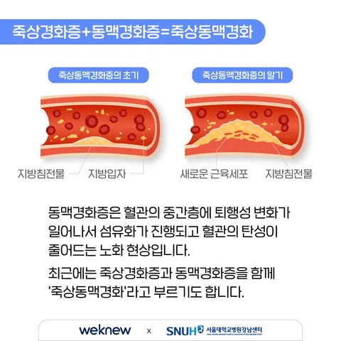 혈관 건강의 적신호, 죽상동맥경화증 1편 3장. 죽상경화증+동맥경화증=죽상동맥경화. (우측 상단 이미지 삽입) 동맥경화증은 혈관의 중간층에 퇴행성 변화가 일어나서 섬유화가 진행되고 혈관의 탄성이 줄어드는 노화 현상입니다. 최근에는 죽상경화증과 동맥경화증을 함께 '죽상동맥경화'라고 부르기도 합니다.